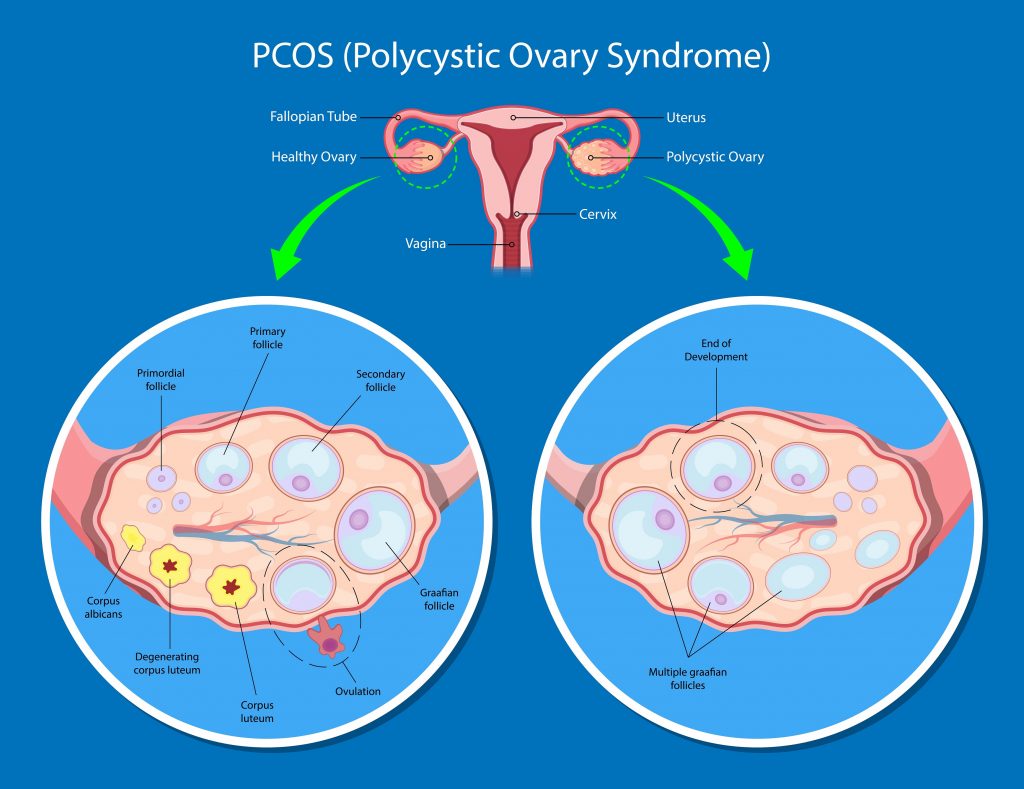 Jak rozwija się PCOS